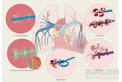 Aventus機械性血栓切除系統(tǒng)獲批FDA，可治療肺栓塞（PE）