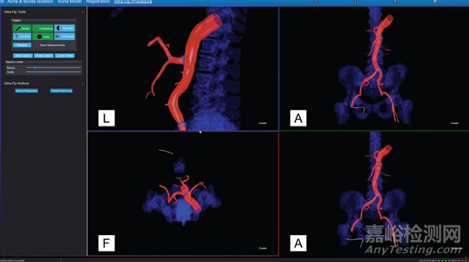因涂層脫落風(fēng)險(xiǎn)，Centerline血管導(dǎo)航導(dǎo)絲一級召回