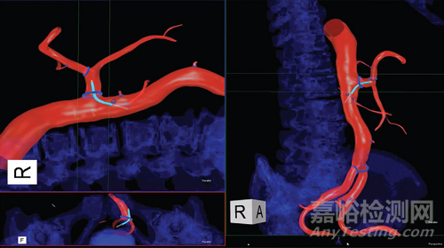 因涂層脫落風(fēng)險(xiǎn)，Centerline血管導(dǎo)航導(dǎo)絲一級召回