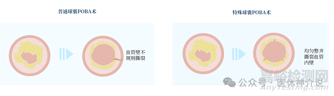 血管介入特殊球囊技術(shù)解析