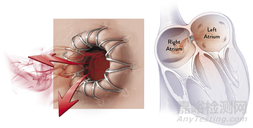 【創(chuàng)新醫(yī)械】全球首款心房分流器