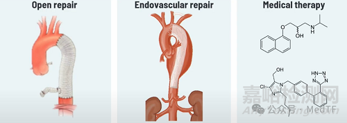 【創(chuàng)新醫(yī)械】AX-GEN01：生物可吸收主動脈夾層修補補片，實現(xiàn)血管壁再生
