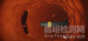 【創(chuàng)新醫(yī)械】AX-GEN01：生物可吸收主動脈夾層修補補片，實現(xiàn)血管壁再生