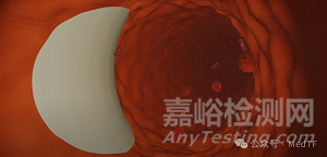 【創(chuàng)新醫(yī)械】AX-GEN01：生物可吸收主動脈夾層修補補片，實現(xiàn)血管壁再生