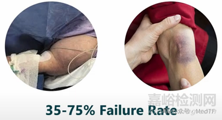 【創(chuàng)新醫(yī)械】Cannulight :將靜脈穿刺成功率提高60%的LED燈