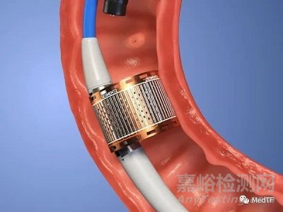 【創(chuàng)新醫(yī)械】ReCET：電脈沖消融治療糖尿病，不僅能改善血糖，而能改善體重和血脂