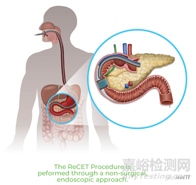 【創(chuàng)新醫(yī)械】ReCET：電脈沖消融治療糖尿病，不僅能改善血糖，而能改善體重和血脂