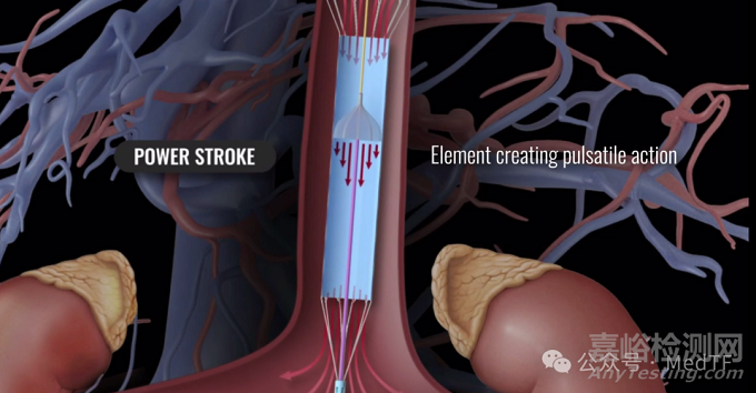 【創(chuàng)新醫(yī)械】LCAPP：搏動式的介入心臟泵