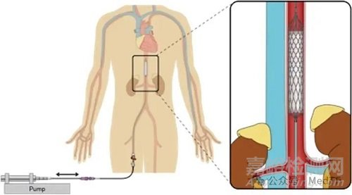 【創(chuàng)新醫(yī)械】LCAPP：搏動式的介入心臟泵