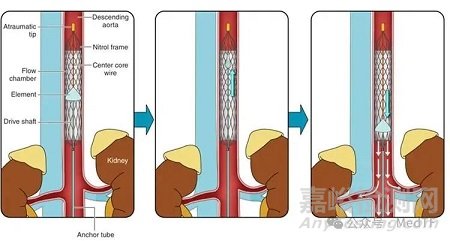 【創(chuàng)新醫(yī)械】LCAPP：搏動式的介入心臟泵