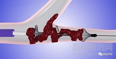 英納瑞創(chuàng)新醫(yī)械 “肺動脈取栓系統(tǒng)”技術(shù)解析
