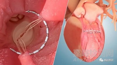 AccuCinch:首款經(jīng)皮修復(fù)心室治療心衰器械完成第一階段臨床入組
