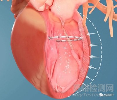 AccuCinch:首款經(jīng)皮修復(fù)心室治療心衰器械完成第一階段臨床入組