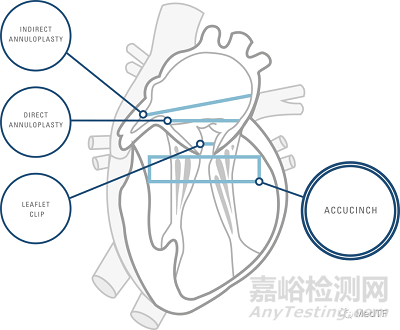 AccuCinch:首款經(jīng)皮修復(fù)心室治療心衰器械完成第一階段臨床入組