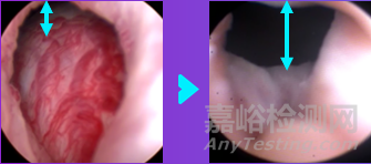 Rezūm：FDA批準波科蒸汽消融新適應癥