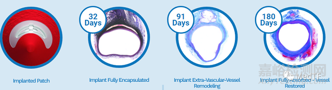 PerQseal Elite：可吸收的大口徑血管閉合器提交FDA注冊(cè)申請(qǐng) | CE批準(zhǔn)其靜脈閉合適應(yīng)癥