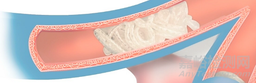 全球首款非金屬外周彈簧圈獲批FDA