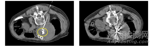 全球首款非金屬外周彈簧圈獲批FDA
