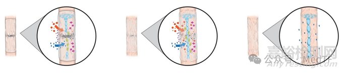 VersaWrap：首款固液雙形態(tài)肌腱修復(fù)水凝膠