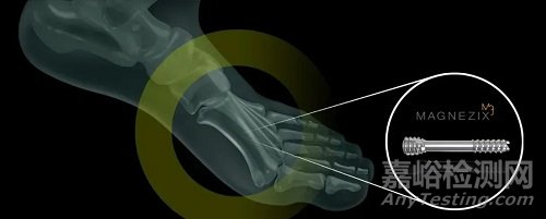 新特利斯創(chuàng)新醫(yī)械“生物可吸收鎂合金加壓螺釘”技術解析