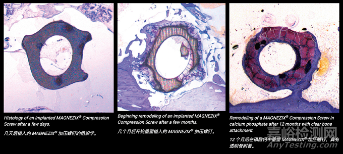 新特利斯創(chuàng)新醫(yī)械“生物可吸收鎂合金加壓螺釘”技術解析