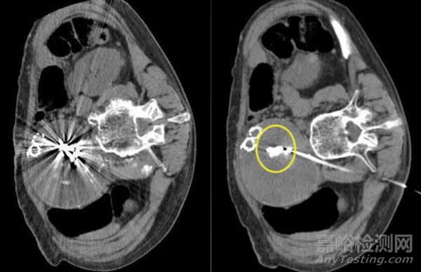 全球首款聚合物基栓塞線圈獲批FDA