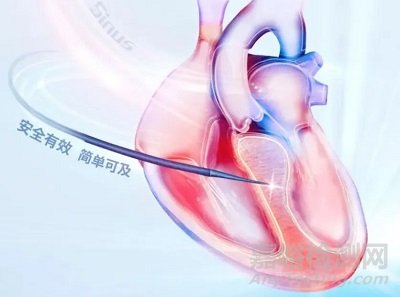 賽納思醫(yī)療創(chuàng)新經(jīng)導(dǎo)管室間隔心肌內(nèi)射頻消融系統(tǒng)技術(shù)解析