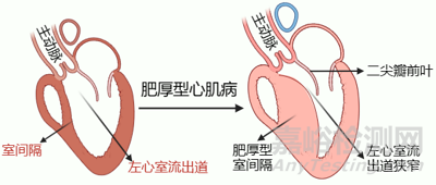 賽納思醫(yī)療創(chuàng)新經(jīng)導(dǎo)管室間隔心肌內(nèi)射頻消融系統(tǒng)技術(shù)解析