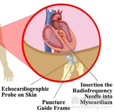 賽納思醫(yī)療創(chuàng)新經(jīng)導(dǎo)管室間隔心肌內(nèi)射頻消融系統(tǒng)技術(shù)解析
