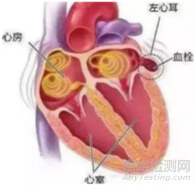 國(guó)產(chǎn)首款V型左心耳閉合系統(tǒng)獲批上市