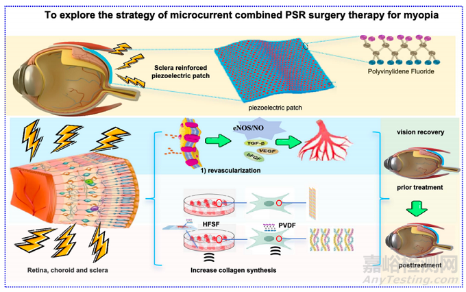 【創(chuàng)新醫(yī)械】新型自發(fā)電驅(qū)動鞏膜加固仿生壓電貼片突破高度近視治療