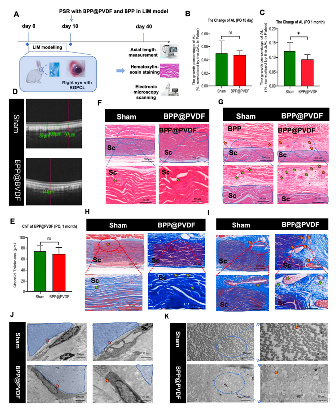 【創(chuàng)新醫(yī)械】新型自發(fā)電驅(qū)動鞏膜加固仿生壓電貼片突破高度近視治療