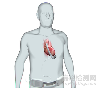 【創(chuàng)新醫(yī)械】基于獨特波浪膜技術(shù)的左心室輔助裝置