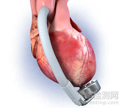 【創(chuàng)新醫(yī)械】基于獨特波浪膜技術(shù)的左心室輔助裝置
