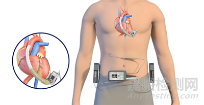 【創(chuàng)新醫(yī)械】基于獨特波浪膜技術(shù)的左心室輔助裝置