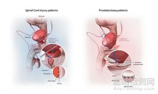 【創(chuàng)新醫(yī)械】CaverSTIM:首款治療勃起功能障礙的植入式神經(jīng)刺激器
