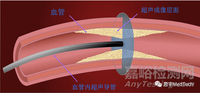 國產(chǎn)首款外周血管內(nèi)超聲導(dǎo)管獲批上市