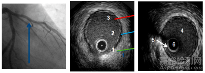 國產(chǎn)首款外周血管內(nèi)超聲導(dǎo)管獲批上市