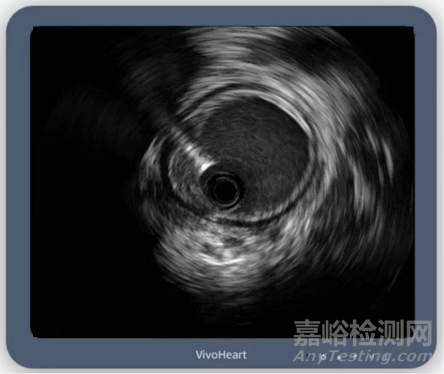 國產(chǎn)首款外周血管內(nèi)超聲導(dǎo)管獲批上市