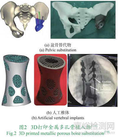 增材制造個(gè)性化植入物技術(shù)發(fā)展與挑戰(zhàn)