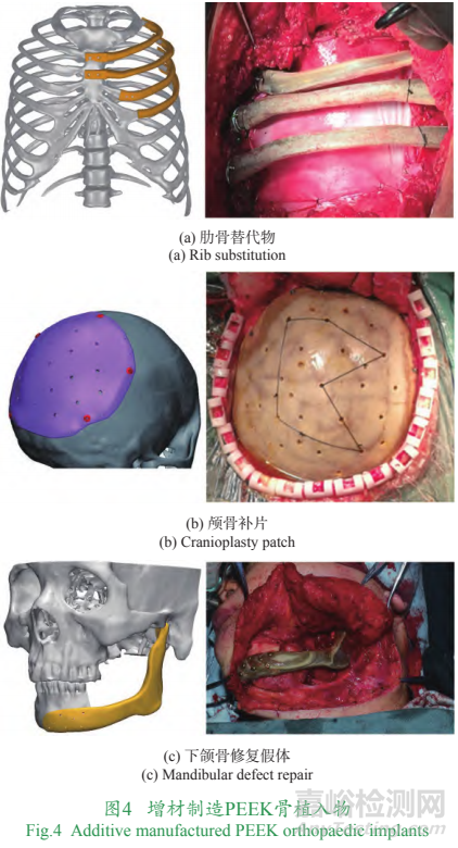 增材制造個(gè)性化植入物技術(shù)發(fā)展與挑戰(zhàn)