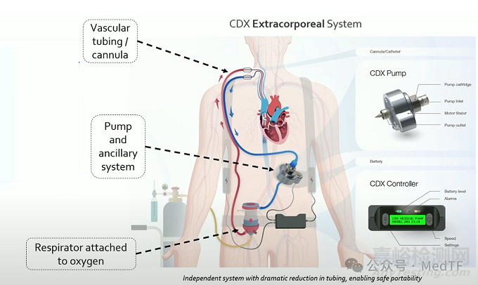 【創(chuàng)新醫(yī)械】CDX：僅8斤重的可穿戴ECMO