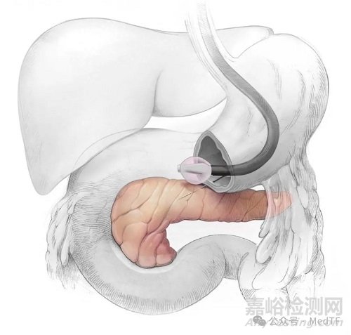 【創(chuàng)新醫(yī)械】REJUVA:胰腺基因療法治療T2D
