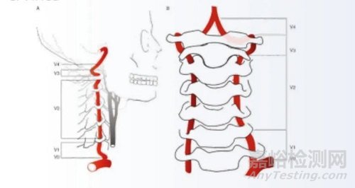 全球首款椎動脈藥物涂層球囊獲批上市