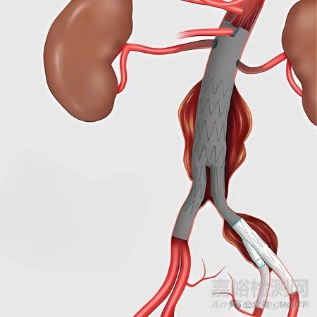 庫(kù)克宣布其髂動(dòng)脈分支覆膜支架ZBIS在美上市
