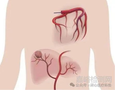 國(guó)產(chǎn)首款可控彎微導(dǎo)管獲批上市