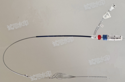 Recana:遠(yuǎn)端帶栓塞收集器的機(jī)械取栓導(dǎo)管完成首例臨床入組