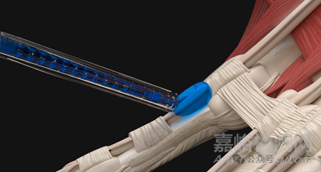 【創(chuàng)新醫(yī)械】B3 GEL：細胞外基質(zhì)水凝膠，避免術(shù)后肌腱黏連