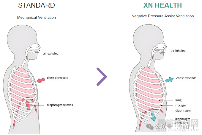 【創(chuàng)新醫(yī)械】Phlex：經(jīng)氣管膈神經(jīng)刺激器械，減少呼吸機(jī)引起的肺損傷
