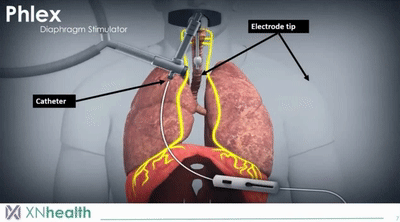 【創(chuàng)新醫(yī)械】Phlex：經(jīng)氣管膈神經(jīng)刺激器械，減少呼吸機(jī)引起的肺損傷